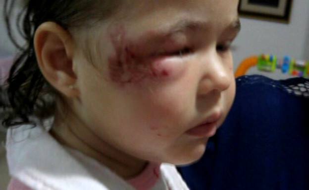 ילדה התעוררה חבולה בפניה בגן ילדים